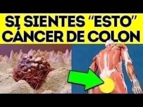 Cáncer de Colon: Causas , Síntomas y Como Prevenirlo